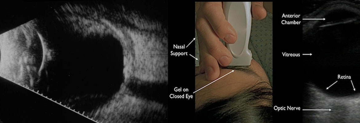 Ocular-Imaging-(Eye-ultrasound-or-B-scan)