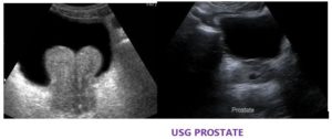 USG PROSTATE